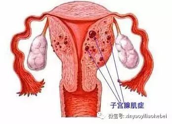 子宫腺疾病最新疗法，女性健康的新希望之光