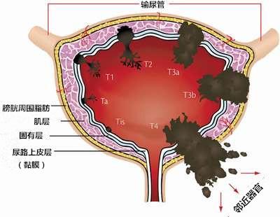 最新膀胱癌治疗方法引领癌症治疗新篇章